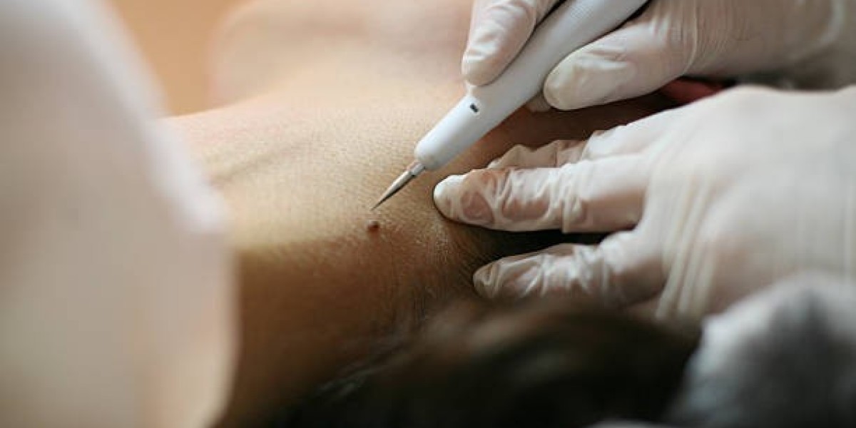 Mole Removal in Dubai: Get Smooth Skin with Expert Care