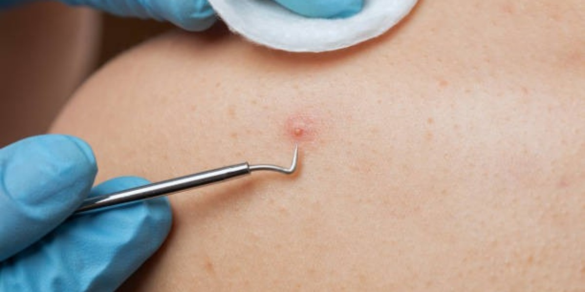 Pimples Treatment in Dubai: Say Goodbye to Acne Now