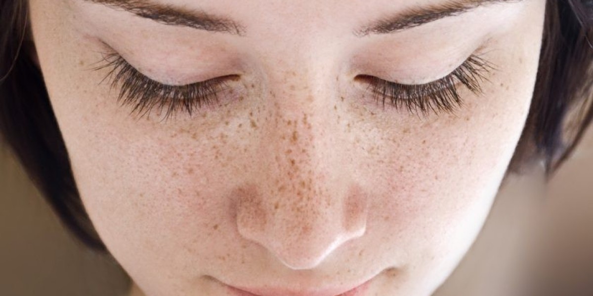 Can Freckles and Blemishes Reappear After Treatment?