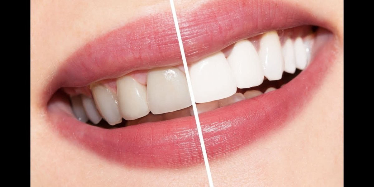 Cosmetic Smile Enhancement in Islamabad