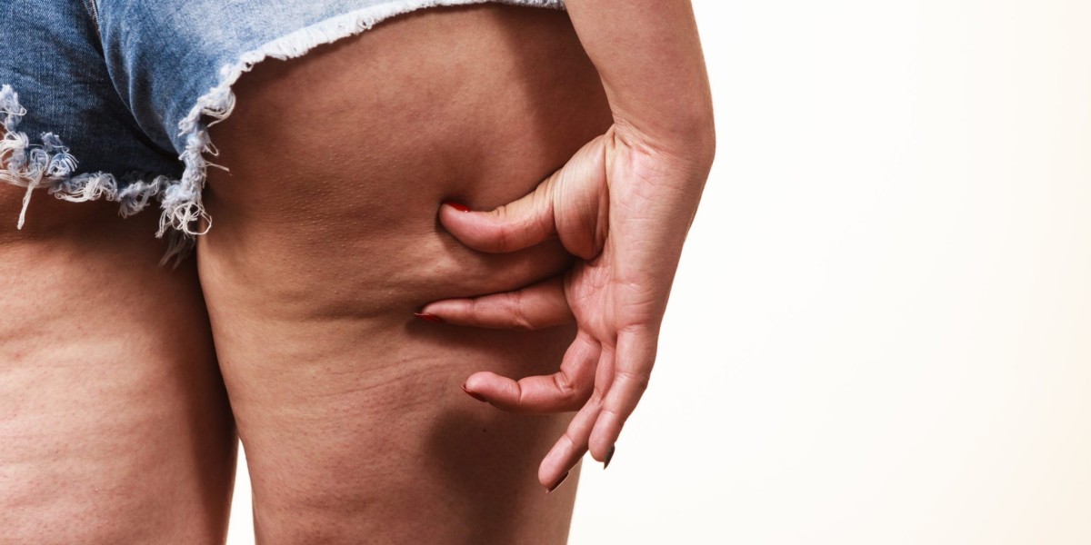 Does Cellulite Treatment Address The Structural Causes?