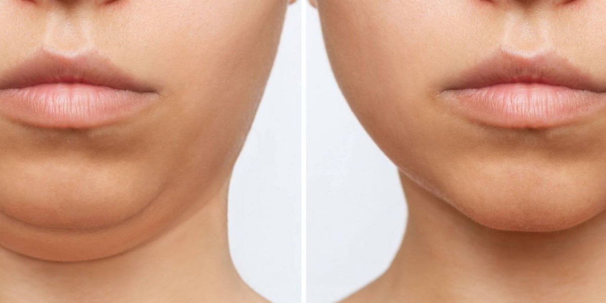 Endolift for Lip Contouring: An Overview