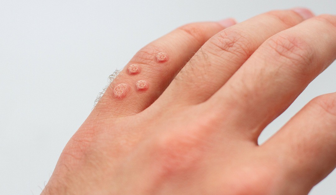 warts removal