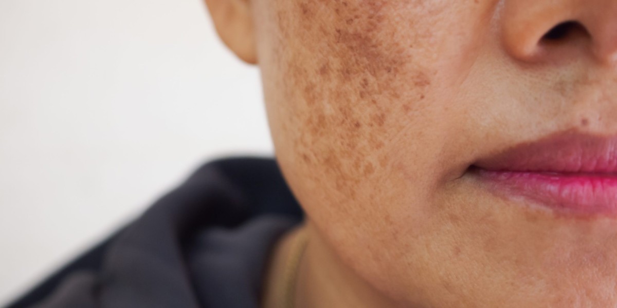 Reveal Spotless, Luminous Skin With Professional Melasma Treatment