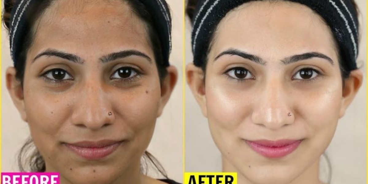 Skin Whitening Treatment Packages in Islamabad