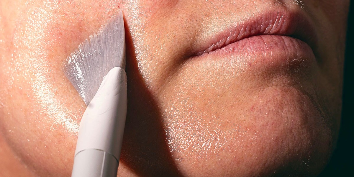 Are Glycolic Acid Peels Safe for Sensitive Skin?