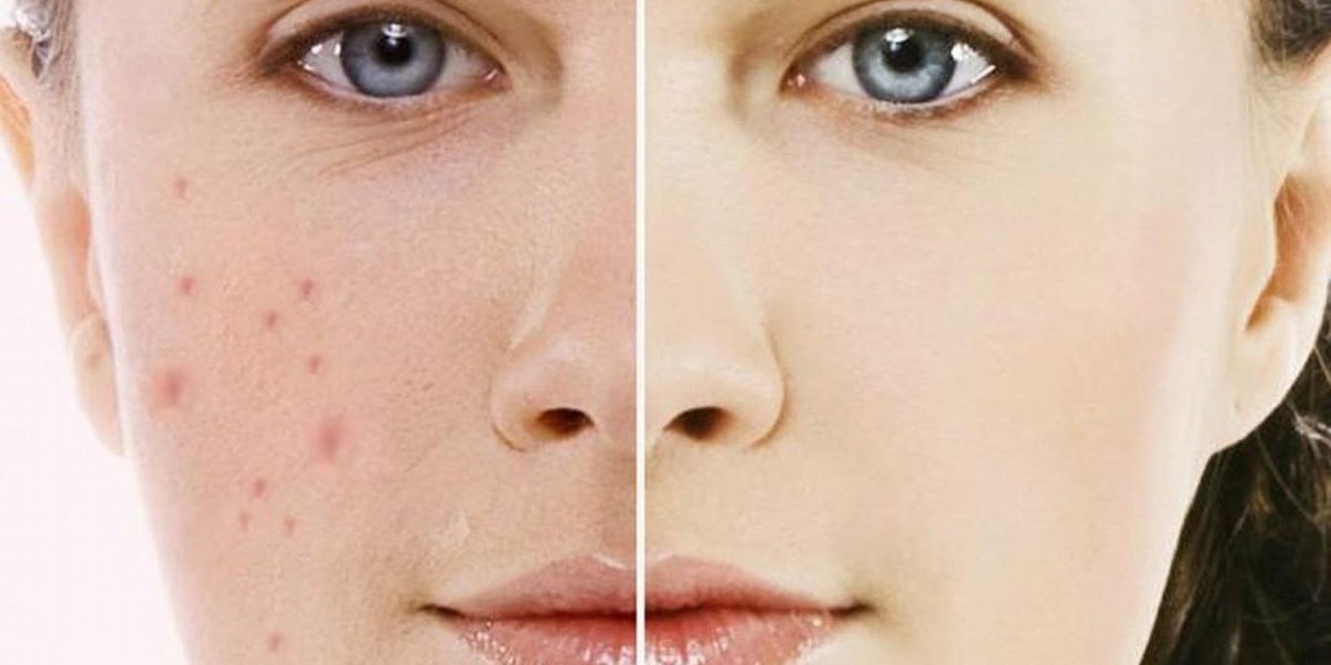 Enhance Appearance Naturally With Best Glutathione Pills For Skin Whitening?