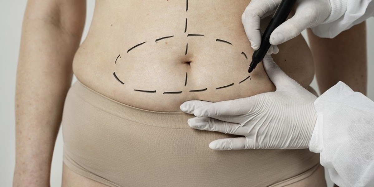 Tummy Tuck Surgery in Riyadh: Exploring Patient Financing Plans