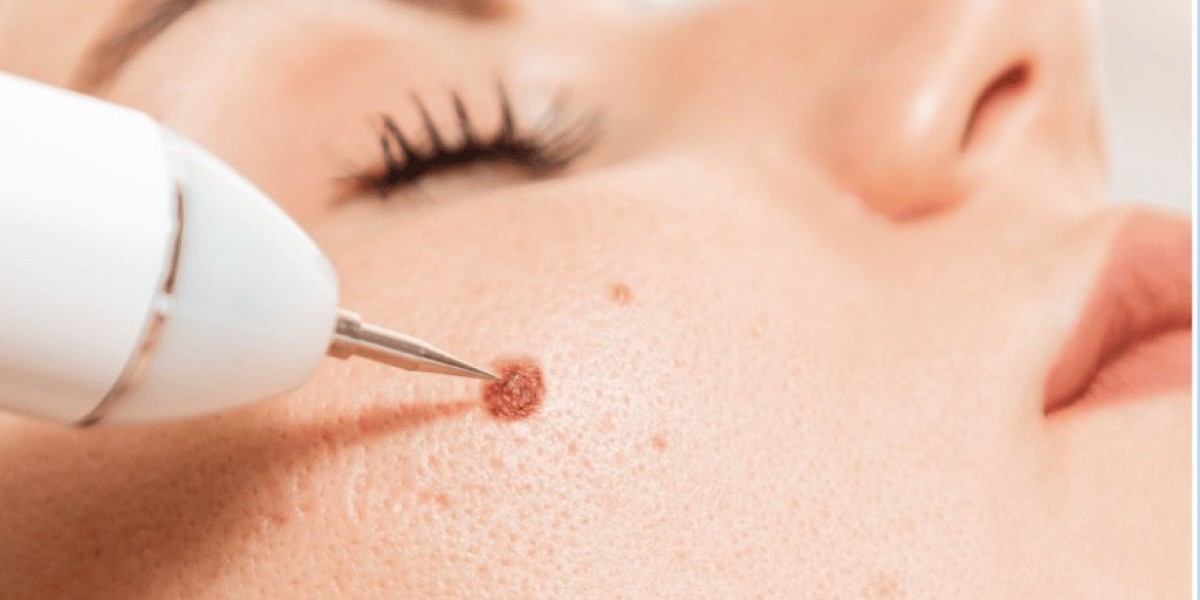 Does Mole Removal Leave Any Noticeable Scarring?