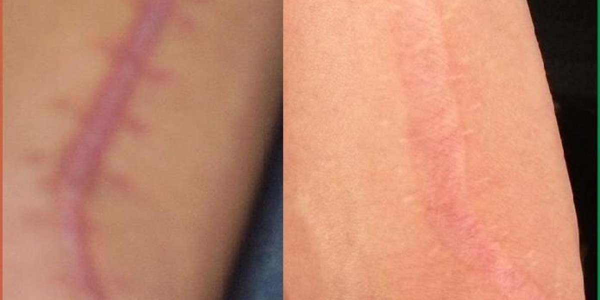 Scar Removal in Dubai: The Role of Laser Technology in Skin Renewal