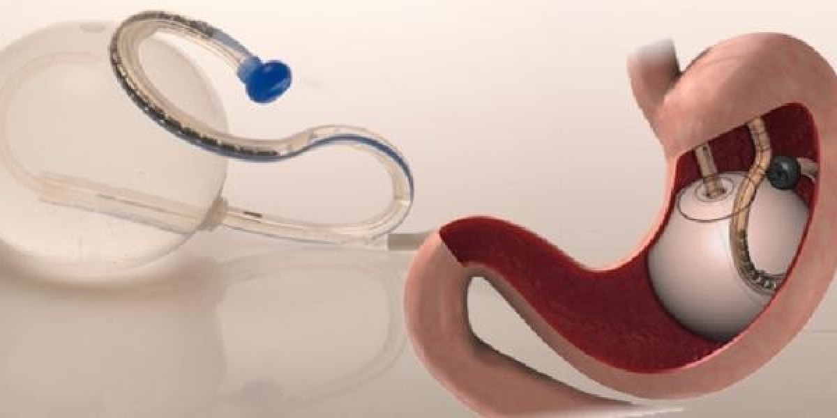 Is Gastric Balloon Therapy Worth the Cost and Commitment?