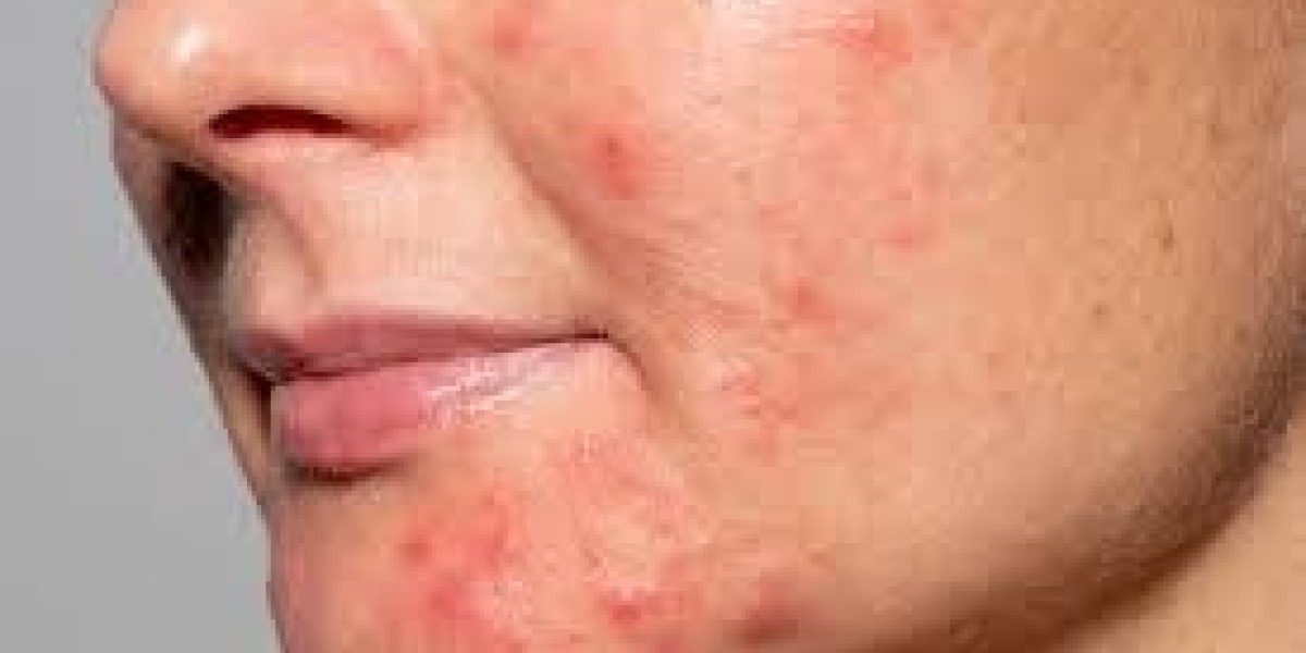What foods can worsen acne on the face?