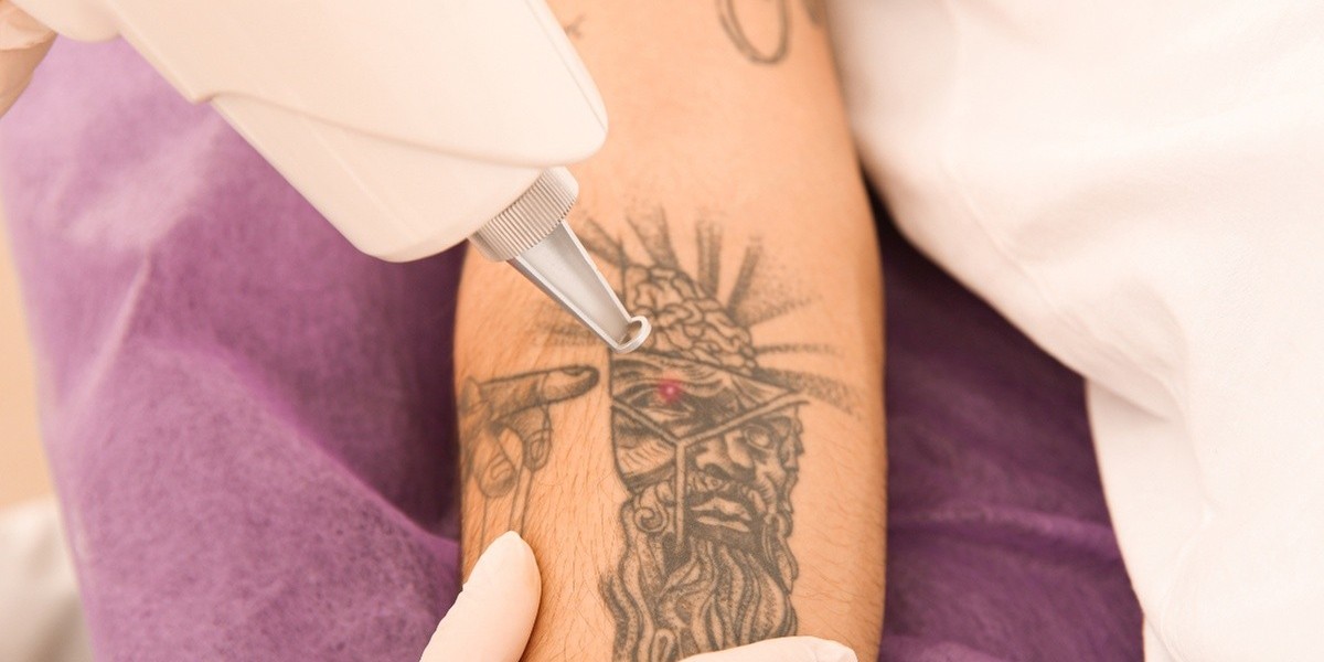 Tattoo Removal in Dubai: Safe Laser Solutions for All Skin Types