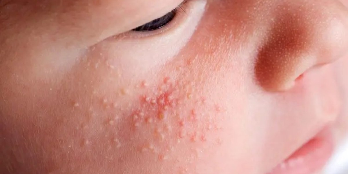 Are Milia Removal Procedures Appropriate for Children?