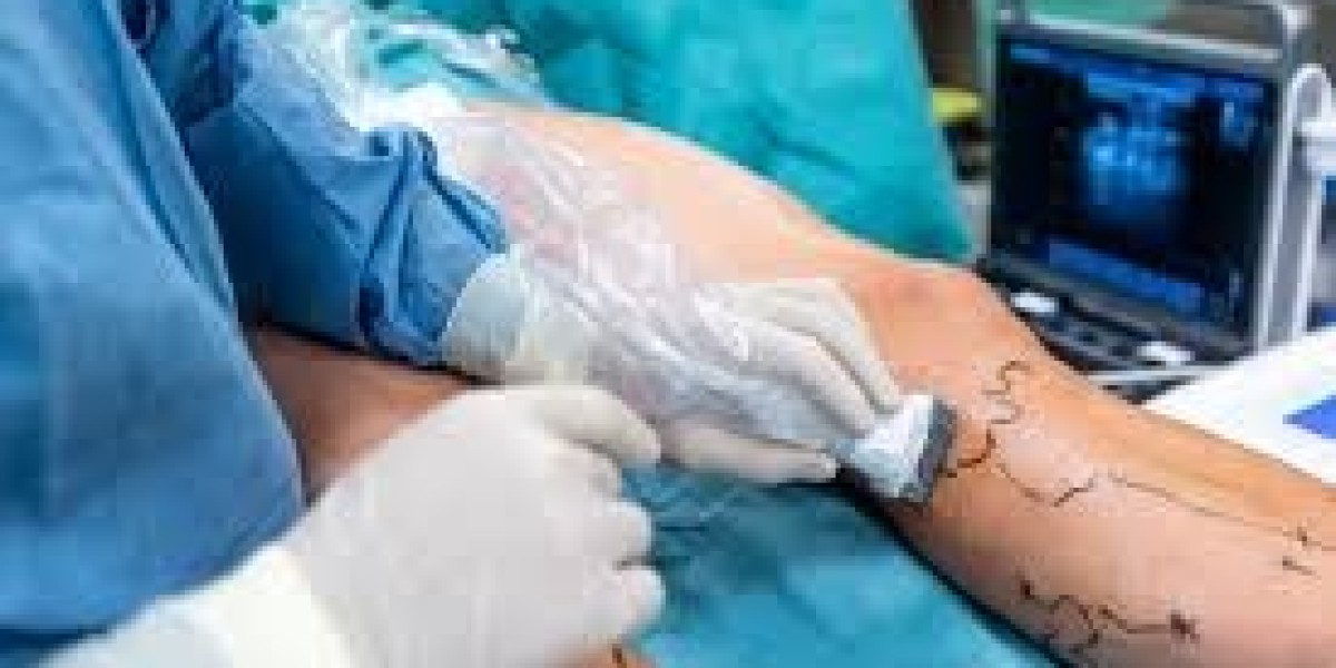 Finding the Best Hospital for Varicose Veins Treatment in India: A Guide with Dr. Sandeep Sharma