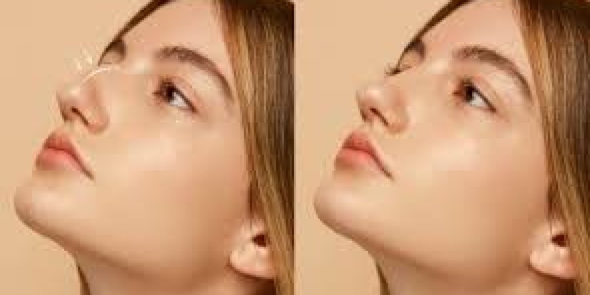 Why Surgeons Recommend Preservation Rhinoplasty in Dubai for Subtle Refinement