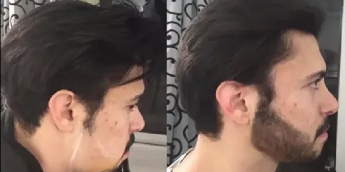 Beard Hair Transplant in Dubai: Restore Your Facial Hair with Confidence