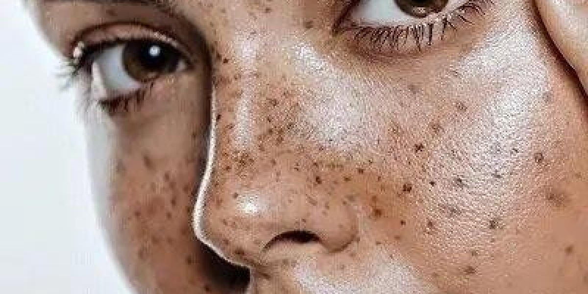 How Many Treatment Sessions Are Needed to Completely Remove Dermal Pigmentation?