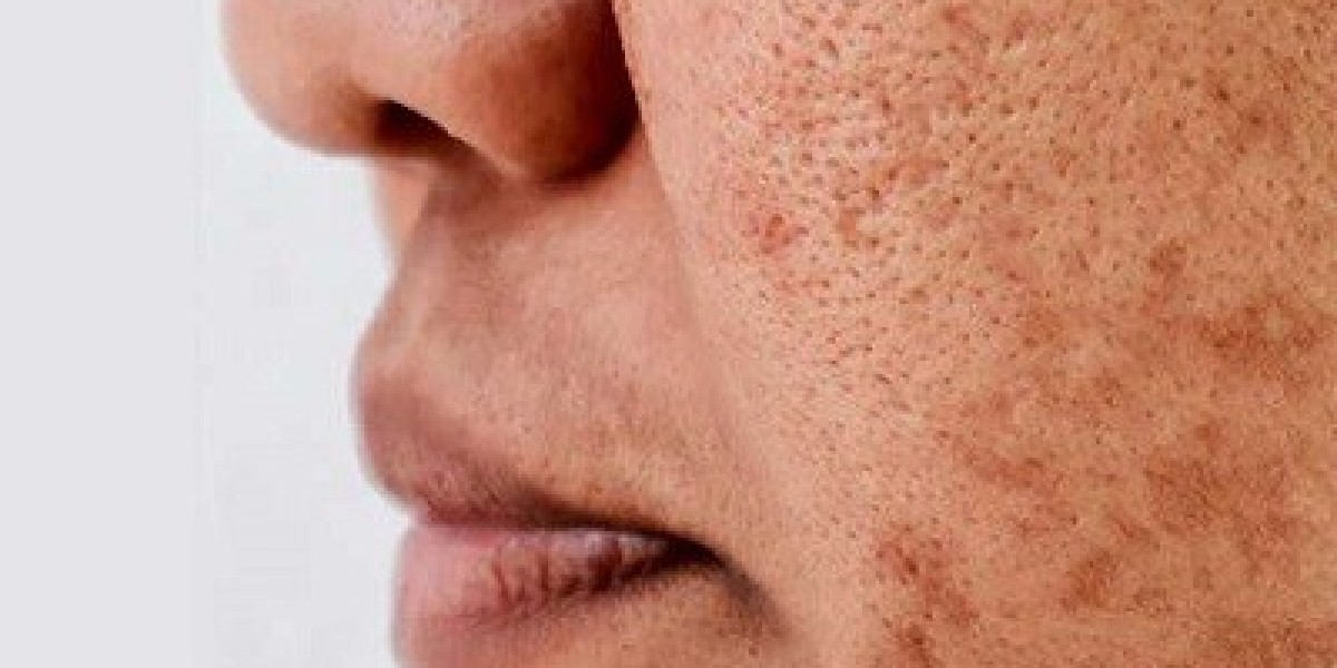 Can Dermal Pigmentation Treatments Help Slow Down Skin Aging?
