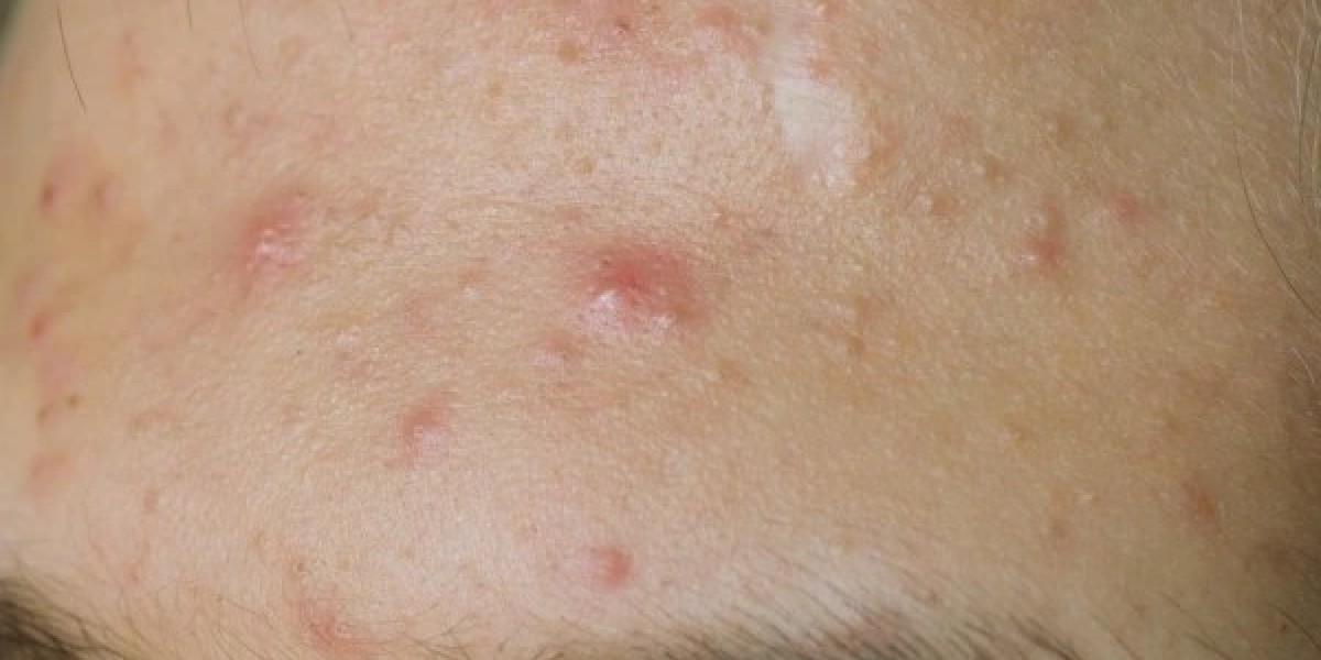 What Pimples Treatment Targets Red Bumps Effectively?