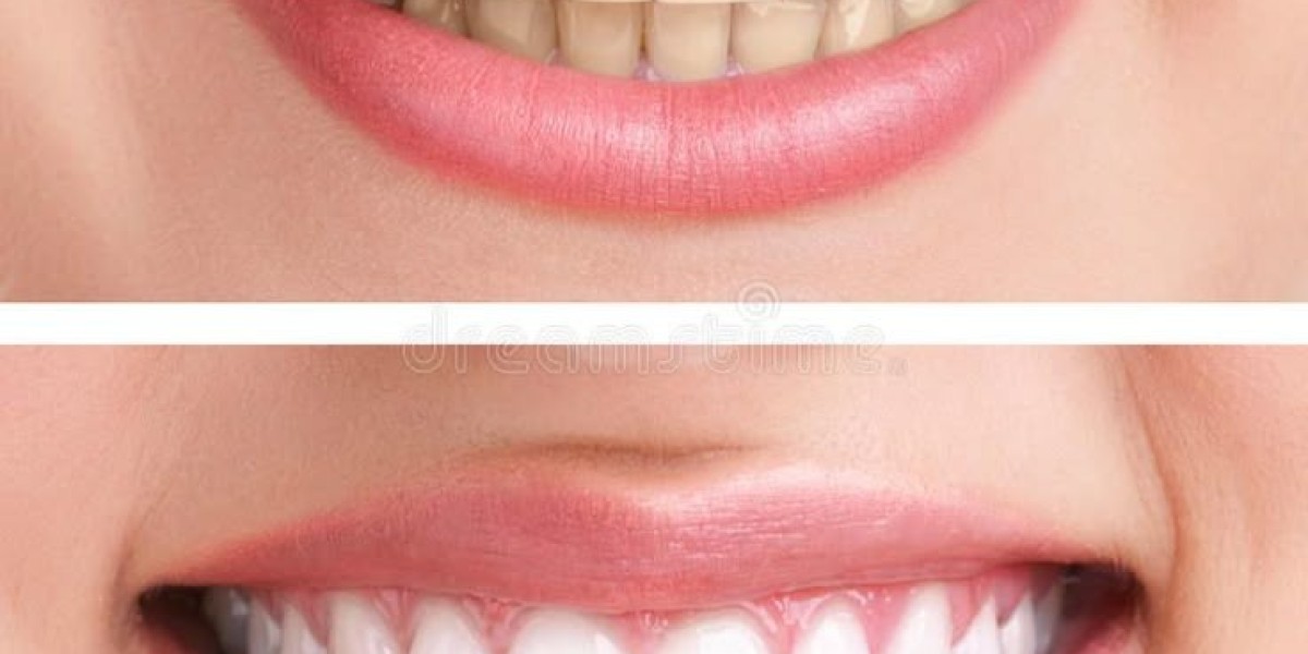 Understanding Root Canal Treatment in Denton: What You Need to Know