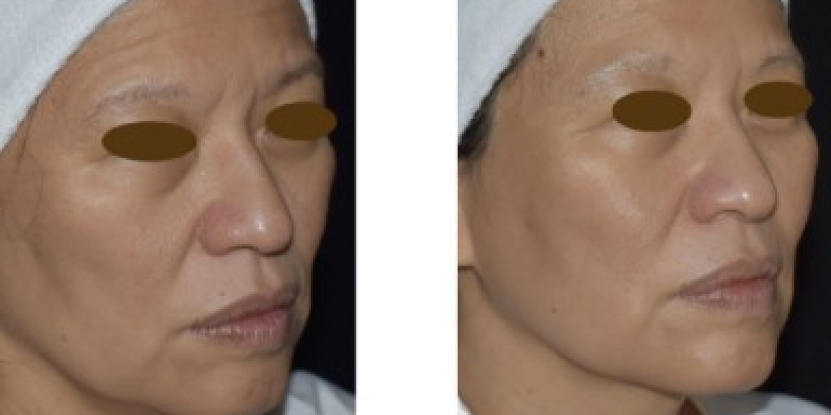 Sculptra: The Secret to Restoring Youthful Volume and Radiance