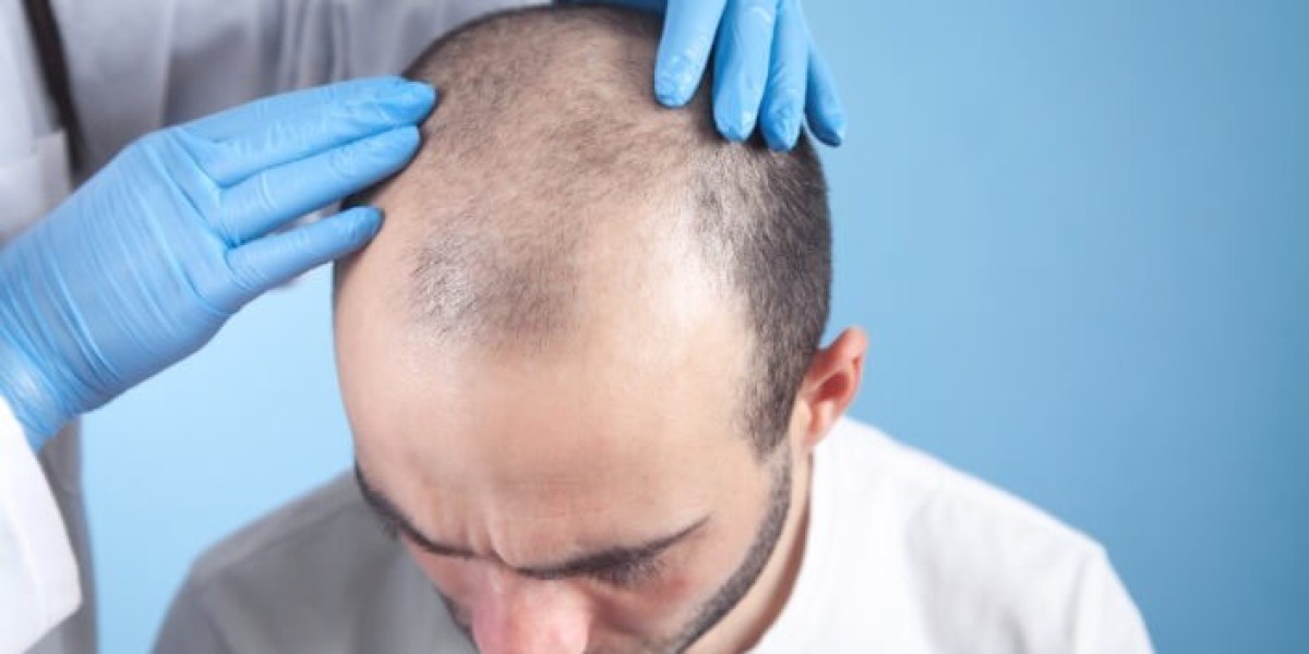 Get the Volume You Deserve with Finasteride for Hair Loss
