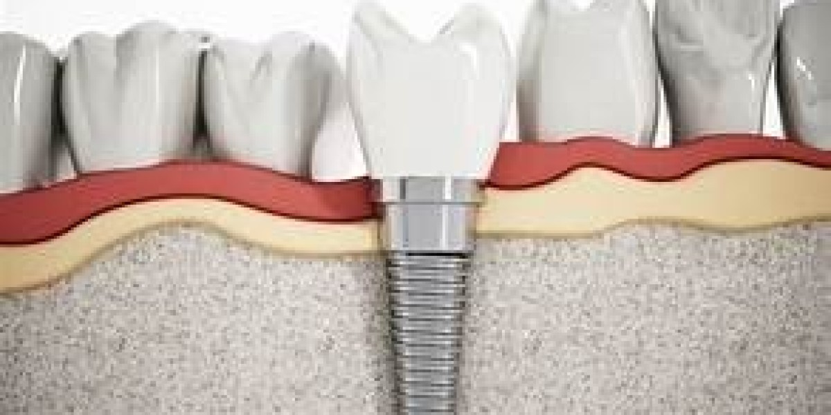 Dental Implants in Virginia (VA): A Complete Guide to Restoring Your Smile