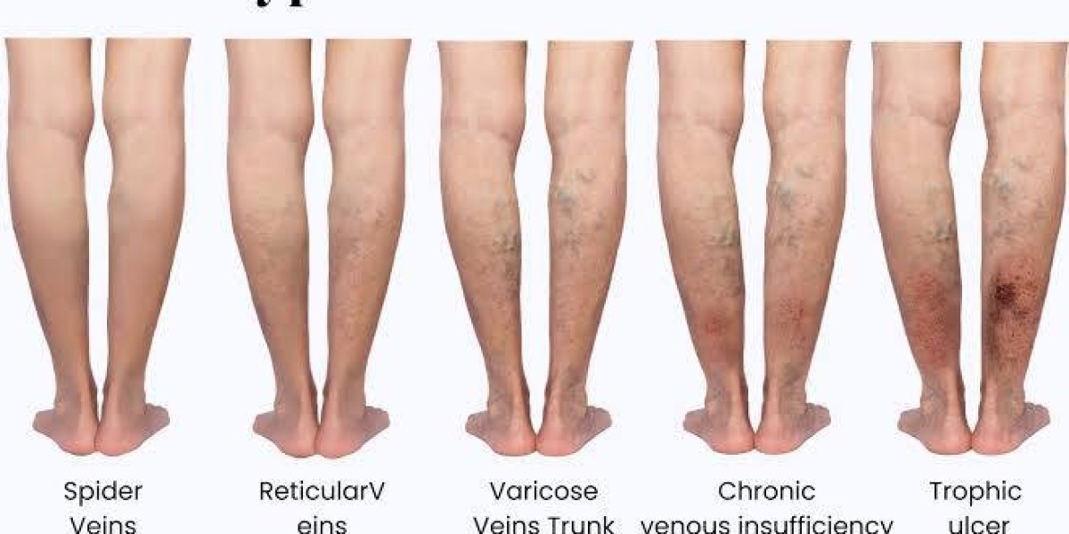 IRfacilities & Dr. Sandeep Sharma: Leading the Way in Varicose Veins Treatment in India