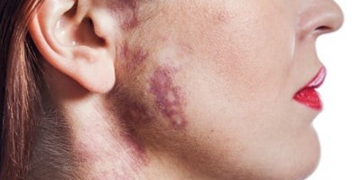 What Are the Most Trusted Medical Treatments for Port Wine Stains?
