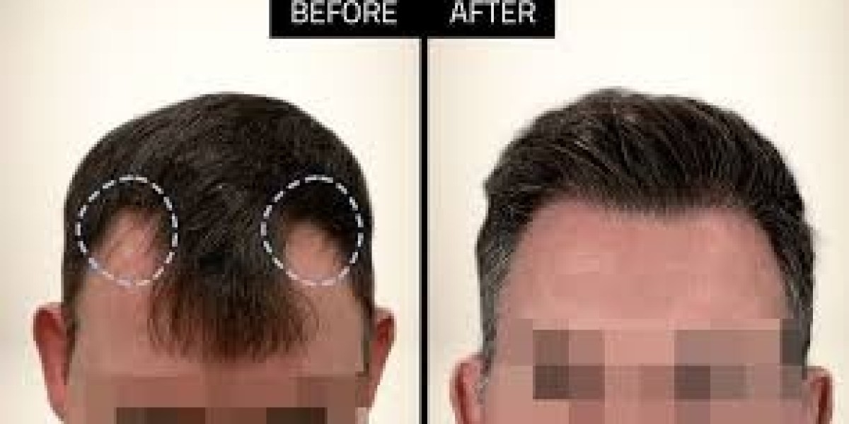 Hair Restoration Market witnessing strong growth fueled by improved follicular unit extraction methods