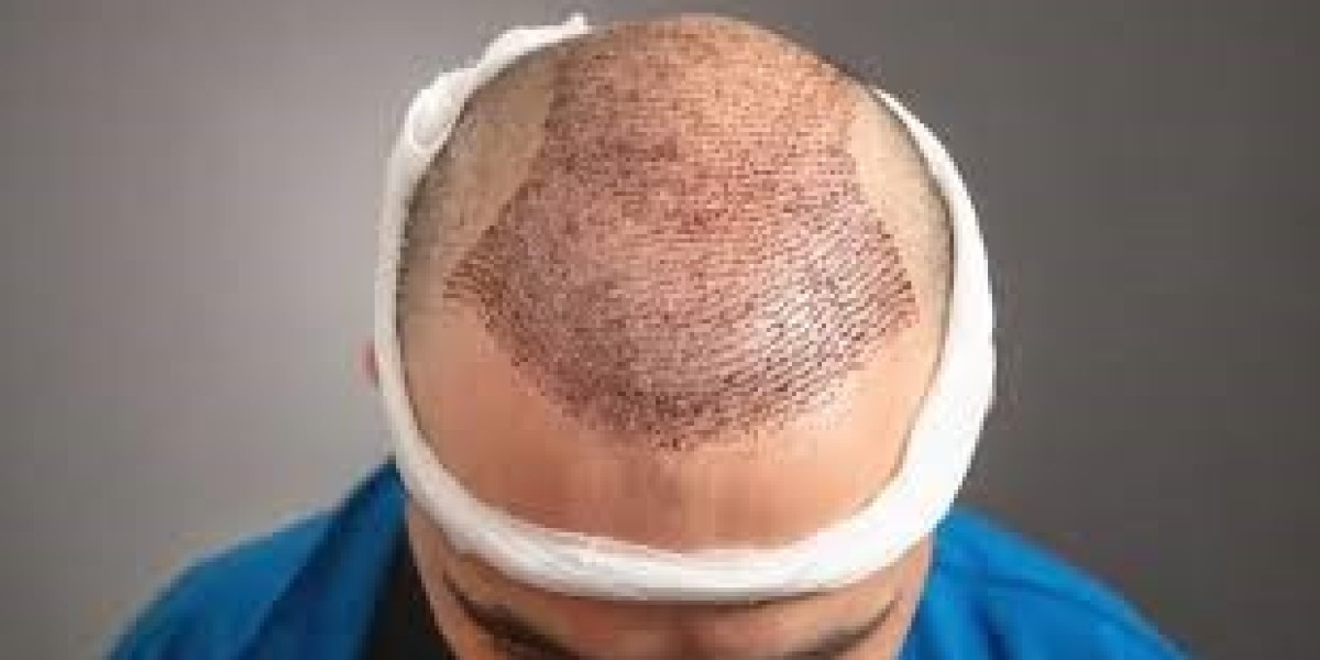 FUE vs. FUT: Which Hair Transplant in Dubai Is Right for You?