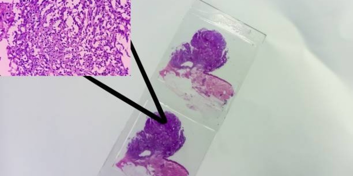 Cancer Biopsy Market Outlook 2025: Innovations, Emerging Techniques & Market Drivers