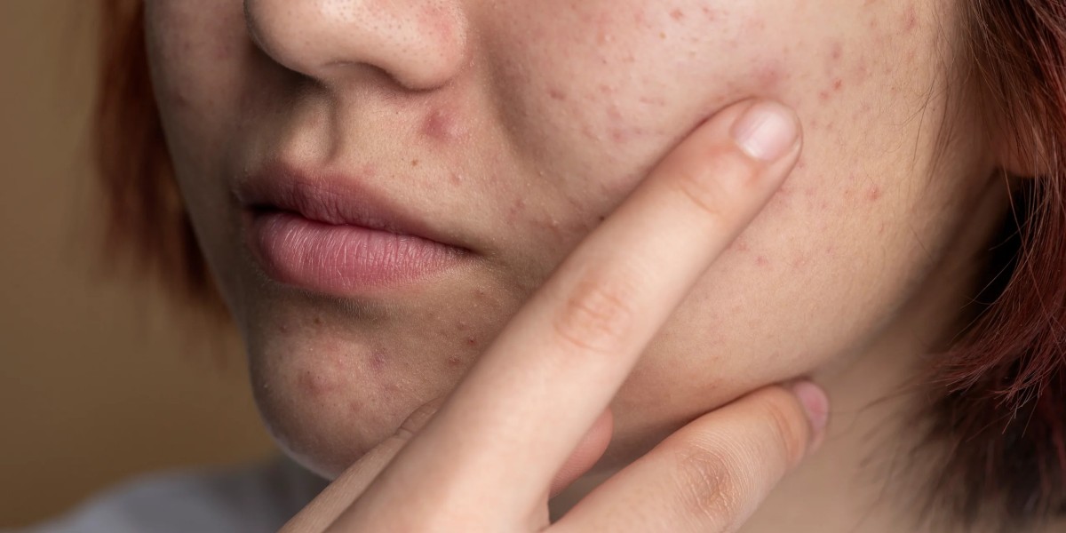 Which Pimples Treatment Options Are Gentle on Sensitive Skin?
