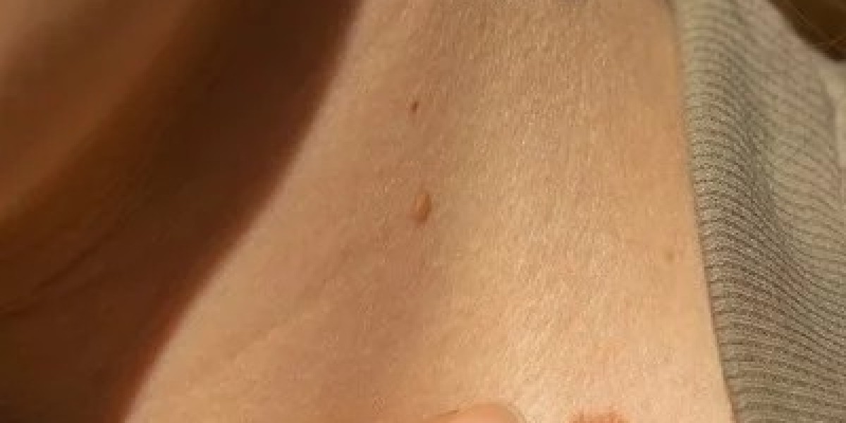 Is Mole Removal a Permanent Solution?