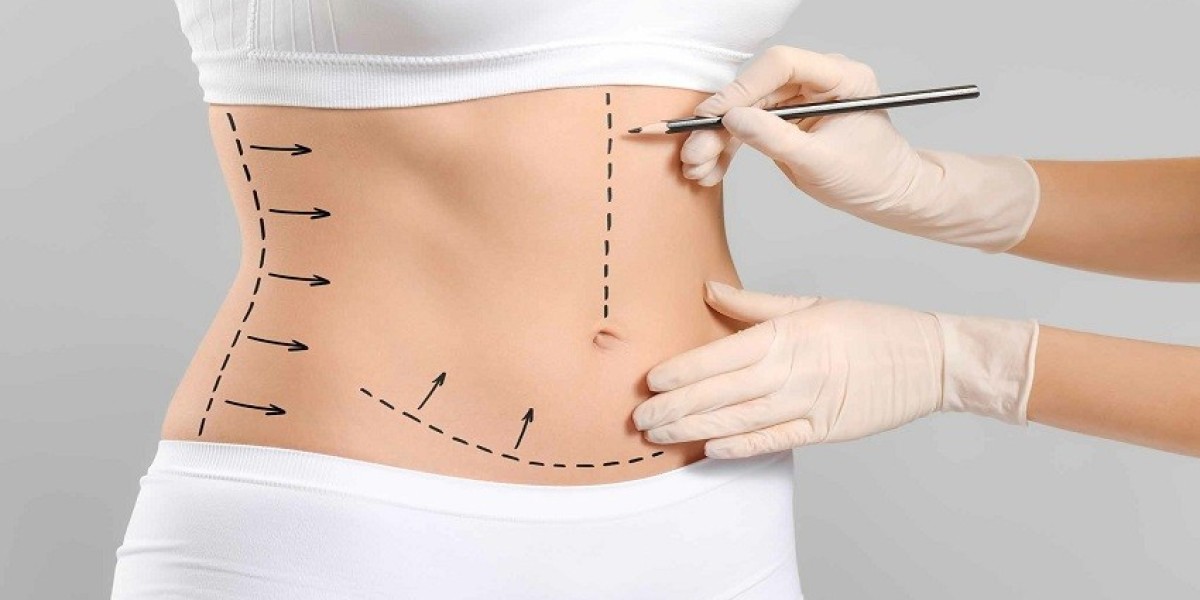 Liposuction Cost in Islamabad – What Affects the Price?