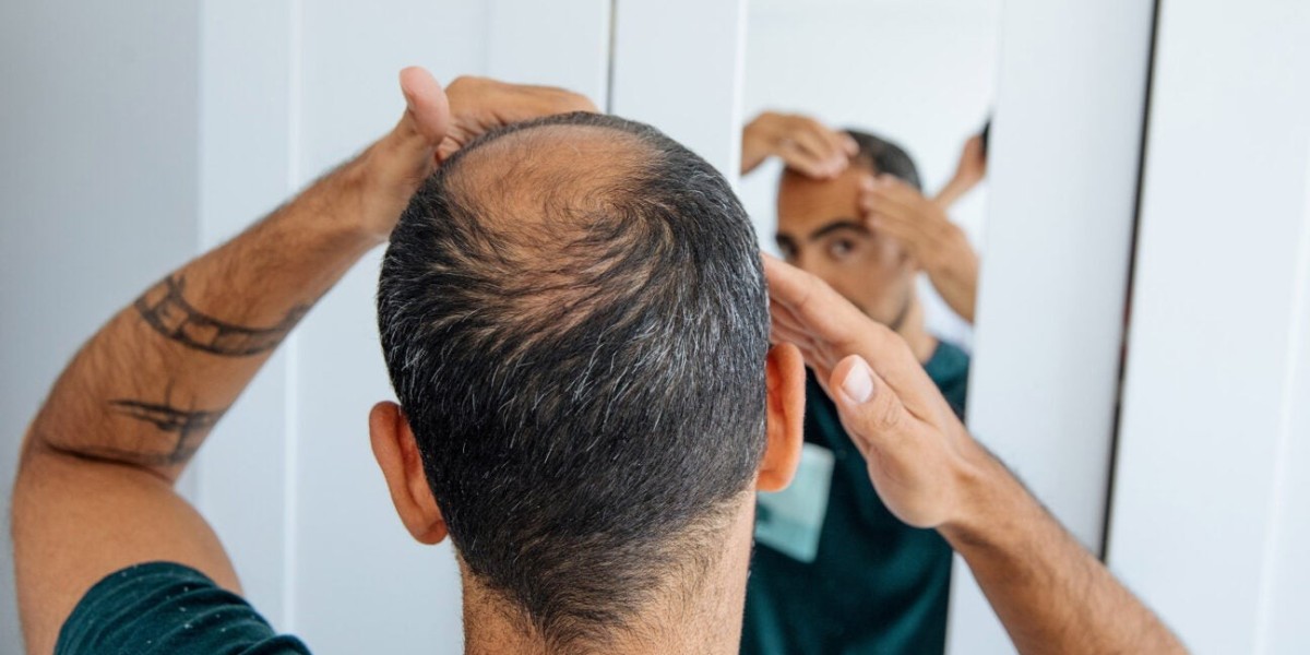 Finasteride 1mg Price and Its Role in Preventing Hair Thinning