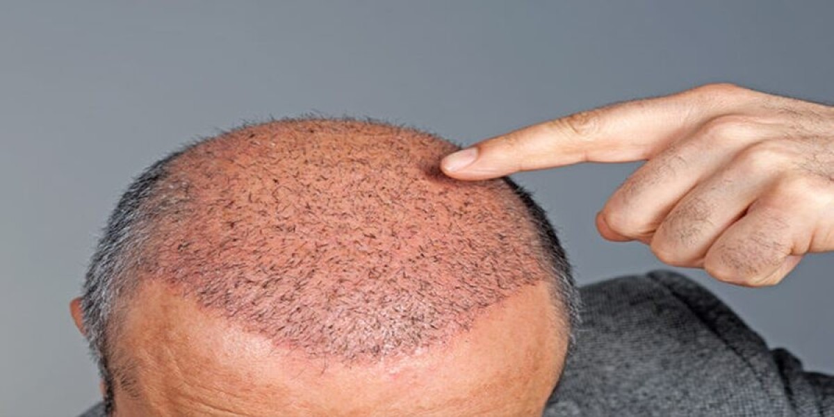 Glamorous Clinic in Dubai: Trusted Hair Grafting Near Me for Men & Women