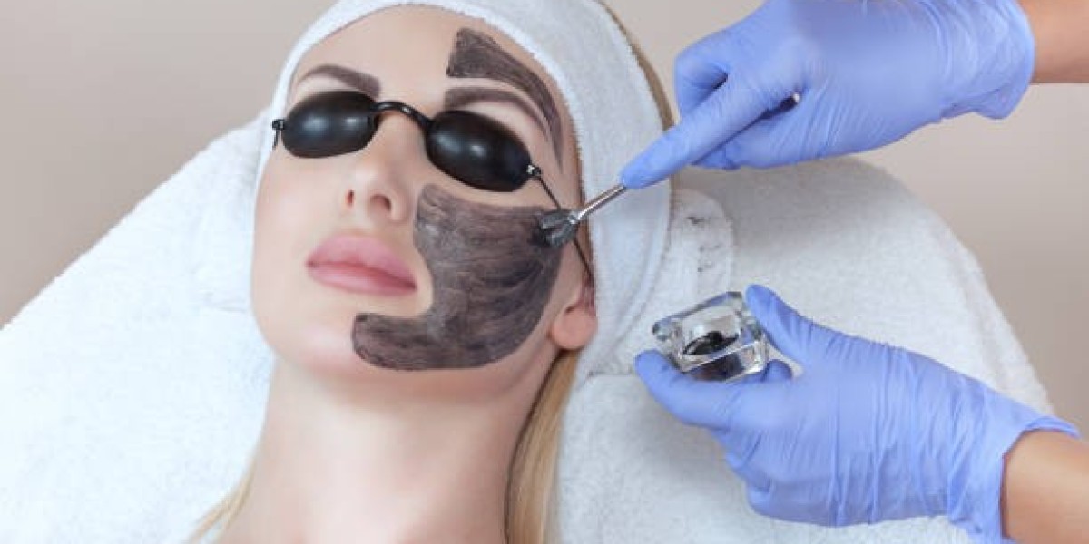 How Laser Carbon Peel in Islamabad Fights Acne Scars