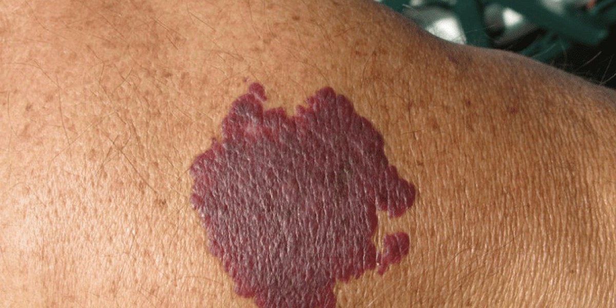 Is Birthmark Removal Effective for Every Skin Type?