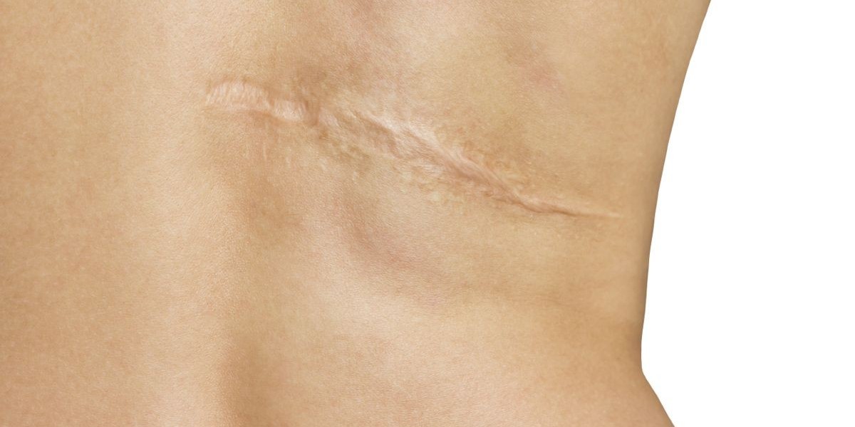 Scar Removal in Dubai: Who is the Ideal Candidate?
