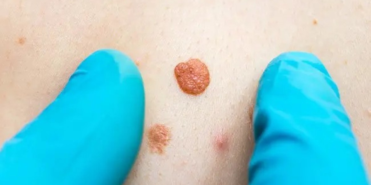 What Benefits Do You Get from Removing Skin Tags?