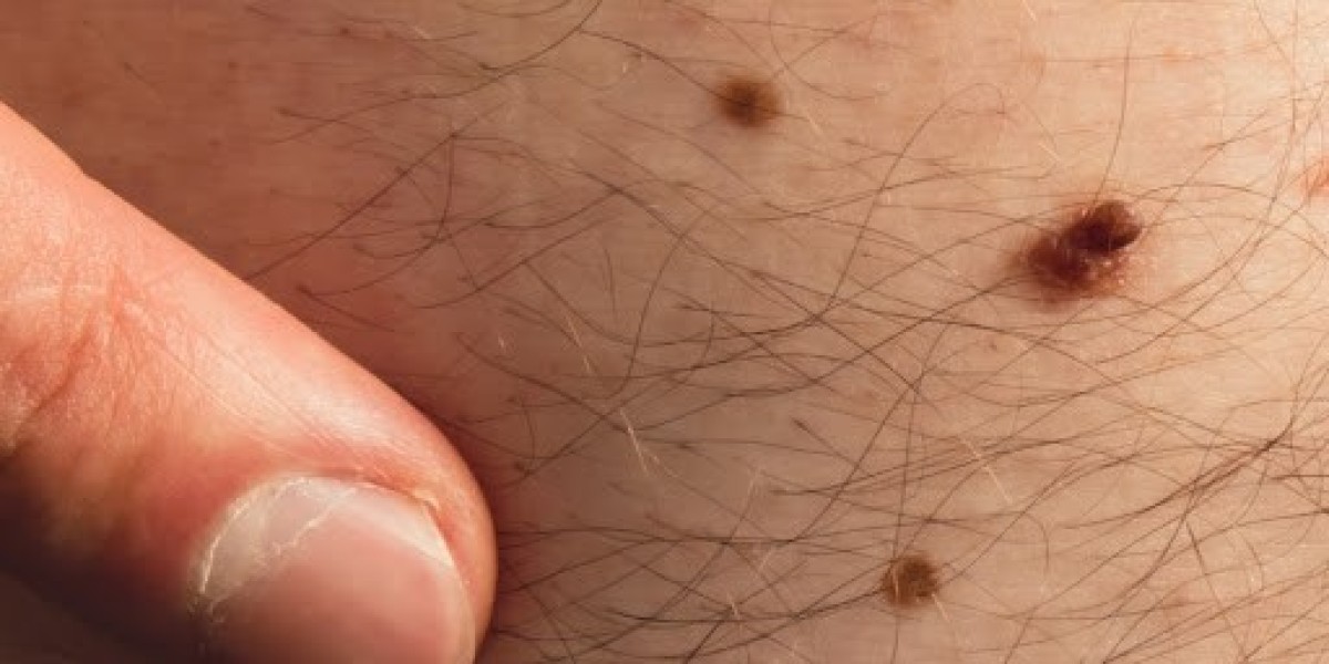 When Is the Right Time to Consider Mole Removal?