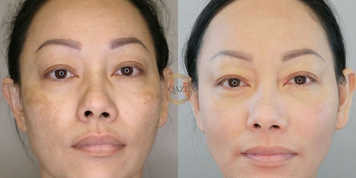 Get Clear Skin at Low Cost – Pigmentation Laser Dubai | Glamorous Clinic