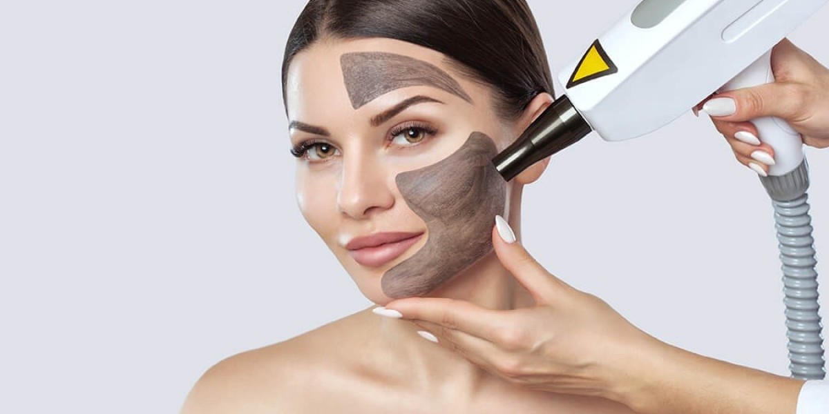 Does Laser Carbon Peel Really Help With Oily Skin?