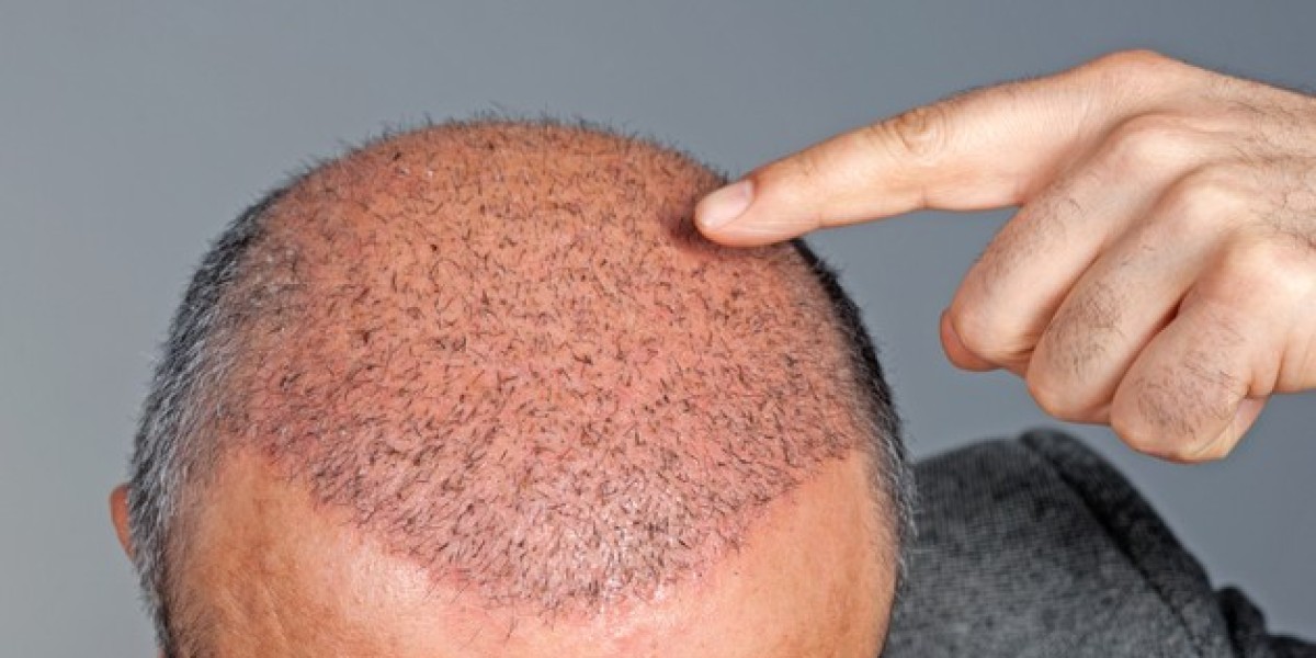 Can robotic hair transplant be done on women too?