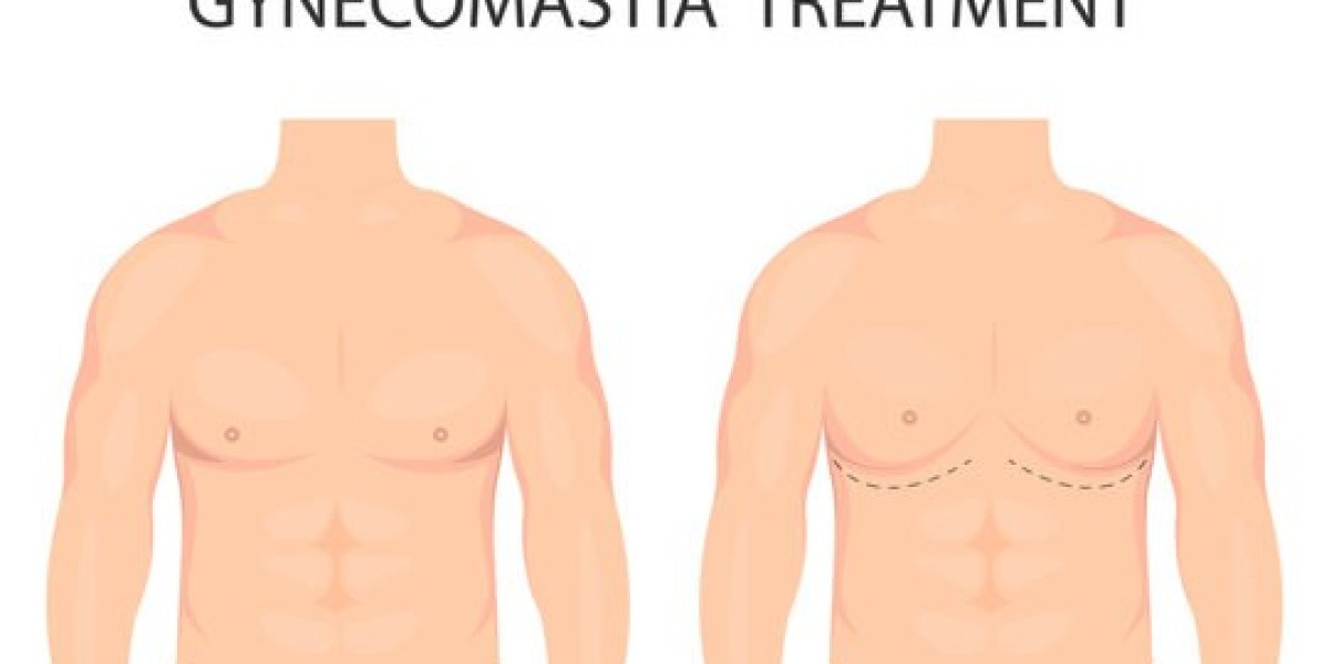 Risks and Complications of Gynecomastia Surgery in Islamabad: A Complete Overview