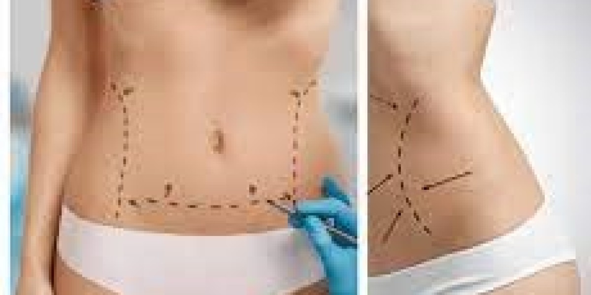 Understanding the Risks and Benefits of Liposuction Surgery in Dubai