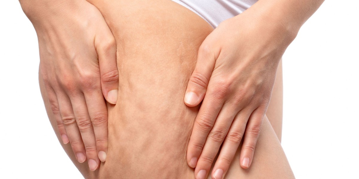 Is the Cellfina Procedure Considered Safe?