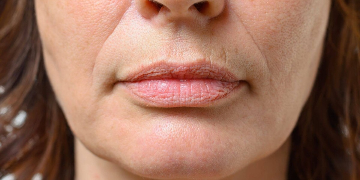 Can Smoker’s Lips Treatments Reduce Fine Lines Around the Mouth?